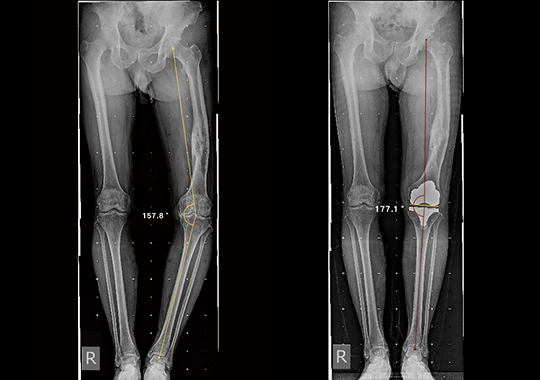 男，70岁，左膝骨关节炎，左股骨干骨折术后，骨折畸形愈合
